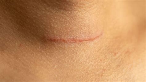 Parathyroidectomy Scar