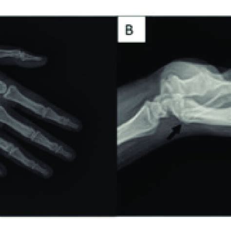 A Ap And B Lateral Radiographs Of The First Arrival At The Hospital