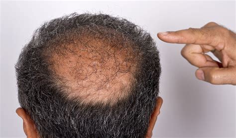 However, it can also be caused by an abnormal reaction of the immune system (alopecia areata), which requires special treatments. From Bald Patches to Thick Locks - How to Grow Your Hair Back