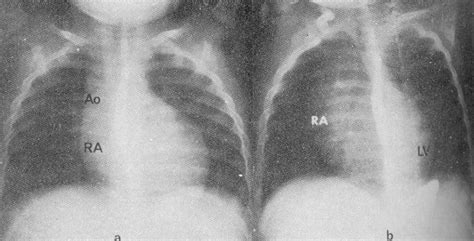Tricuspid Atresia Chest X Ray Wikidoc