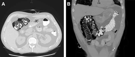 A 54 Year Old Man Presenting With An Abnormal Abdominal Ct