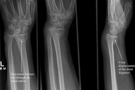 Bartons Fracture Hand Or Distal Joint Articulated To Distal