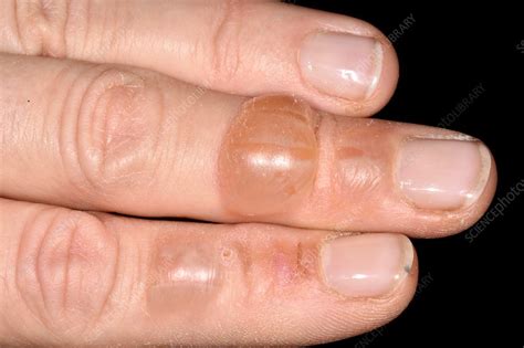 Blisters Following Burn Injury Stock Image C0381708 Science