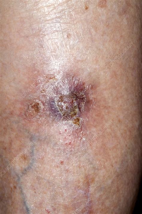 Wound After Skin Cancer Removal Stock Image C0142811 Science