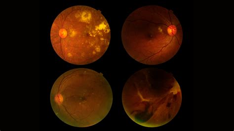 Automated Diagnosing Primary Open Angle Glaucoma From Fundus Image By