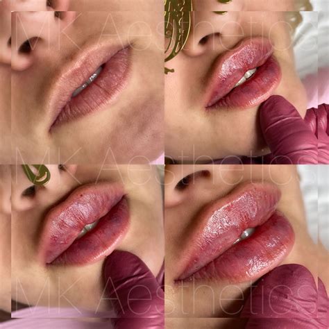 Russian Lips Used 0 8ml Dermal Fillers Lips Lip Fillers Lip