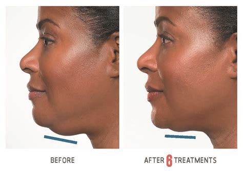 Kybella Double Chin Injection Fargo Center For Plastic Surgery