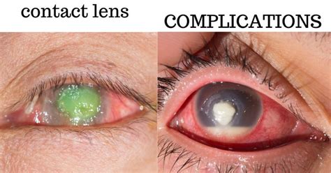 Complications From Contact Lenses Bceye Board Certified Eye Doctors Burlington Bucks