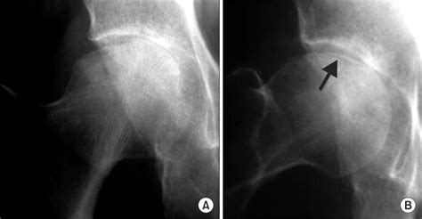 A 68 Year Old Woman With A Subchondral Insufficiency Fracture Of The