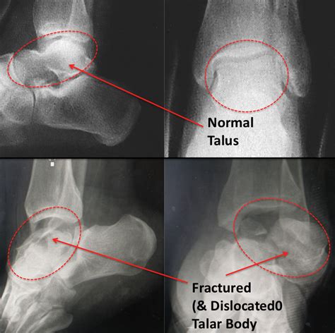 Talar Body Fracture Footeducation