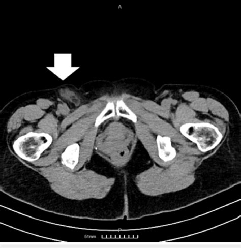 An Axial View Of The Ct Showing A Femoral Hernia Containing The
