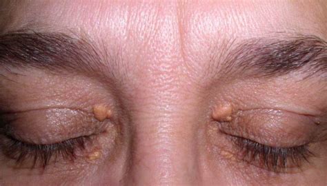 Cholesterol Deposits In The Eyes Causes And How To Get Rid Of Them