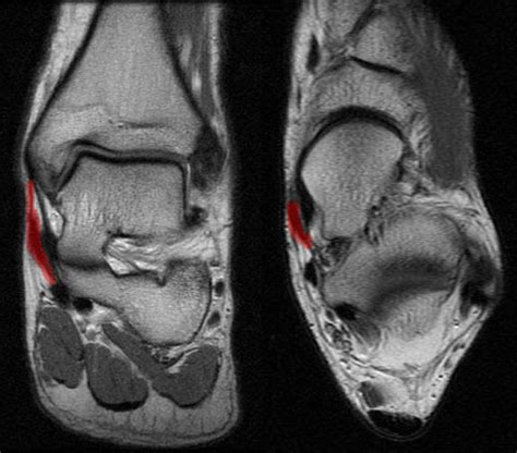 The abductor digiti minimi (adm) muscle is on the lateral side of the foot and contributes to the large lateral plantar eminence on the sole. Muscles Of The Foot Mri / MRI of the Ankle: Detailed ...