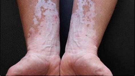 Le Vitiligo Une Maladie De La Peau Peu Connue Lindependantfr