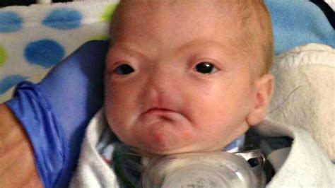 Baby With Rare Condition Born Without A Nose 1023 Krmg