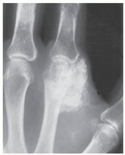 Extraskeletal Osseous And Cartilaginous Lesions Radiology Key
