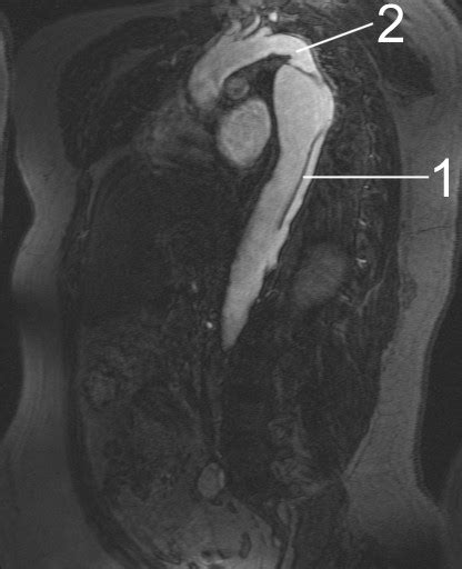 Aortic Dissection Mri Wikidoc