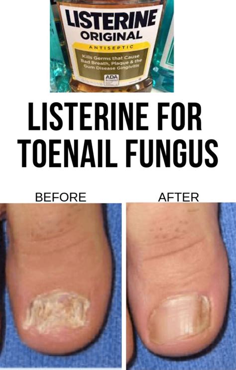 Best Listerine For Toenail Fungus In 2021 And Beyond Nail Fungus Cure