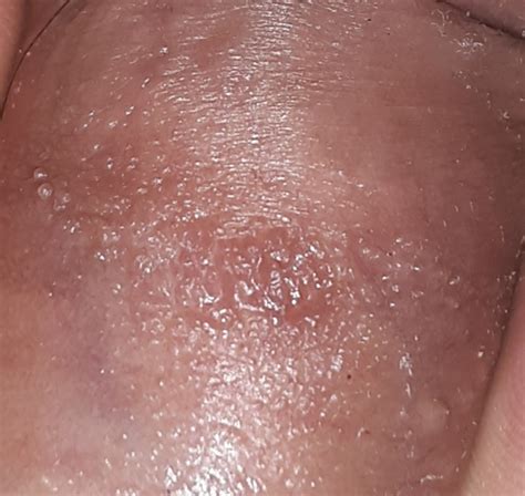 Are These Warts Sexual Health Forums Patient | Free Hot Nude Porn Pic  Gallery