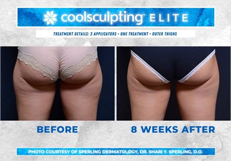 Thighs Coolsculpting Before And After Patient 40 Sperling Dermatology