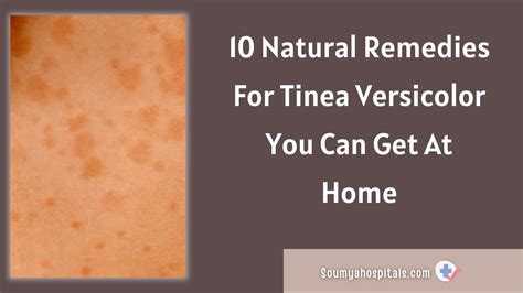 10 Natural Remedies For Tinea Versicolor You Can Get At Home