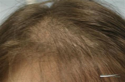 Update More Than Pcos Causing Hair Loss Latest Camera Edu Vn