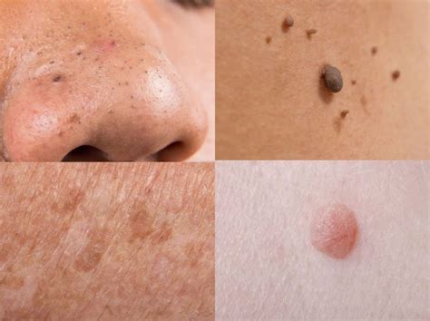 Do This To Naturally Cure Age Spots Moles Skin Tags Warts And