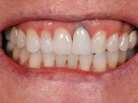 Are Titanium Dental Implants Safe - Metal Allergies | Dental implants cost, Dental, Dental ...