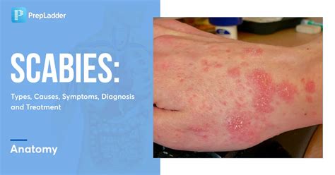 SCABIES Types Causes Symptoms Diagnosis And Treatment