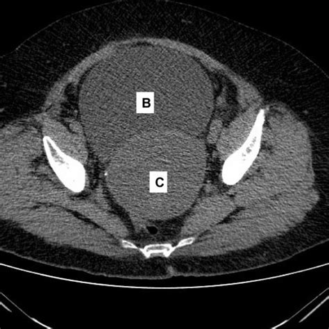 The following list of medications are in some way related to, or used in the treatment of this condition. (PDF) Endometrial Cancer Presenting as Acute Urinary ...