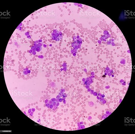 Acute Myeloid Leukemia Smear Show Monocytes And Mostly Blast Cell