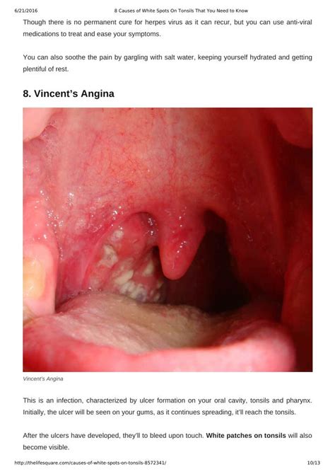Ppt Causes Of White Spots On Tonsils You May Not Know Powerpoint Presentation Id