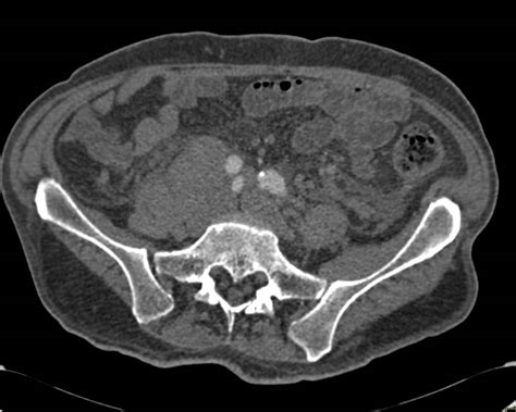 Lymphoma With Bulky Paraaortic Adenopathy Gastrointestinal Case