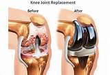 Pain Management After Knee Replacement Surgery Images