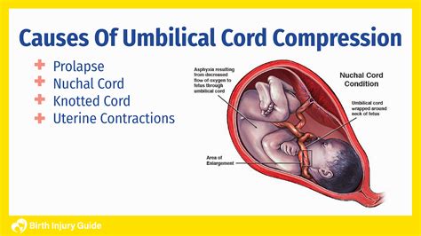 Umbilical Cord Compression And Your Babys Health Birth Injury Guide