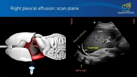 Pleural Effusion The ‘spine Sign Nephropocus