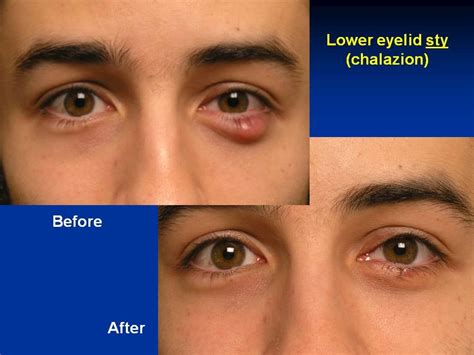 Eyelid Chalazion Stye Blepharitis Procedure Beverly Hills Ca Reverasite