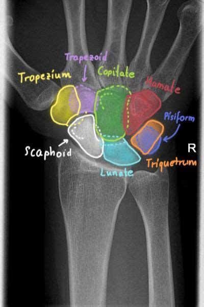 Wrist Xray Anatomy Radiology Medical Anatomy Physical Therapy Assistant