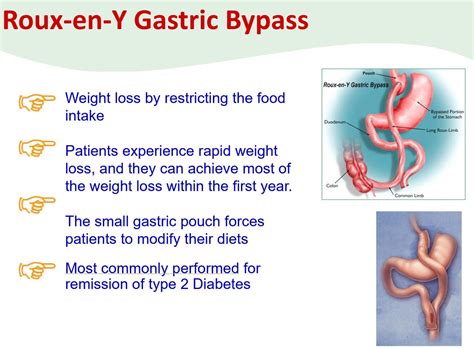 Bariatric And Metabolic Surgery Singapore Arden Jr Surgery