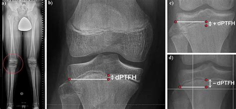 A The Distance Between The Center Of The Proximal Tibial Growth Plate