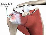 Pictures of Rotator Cuff