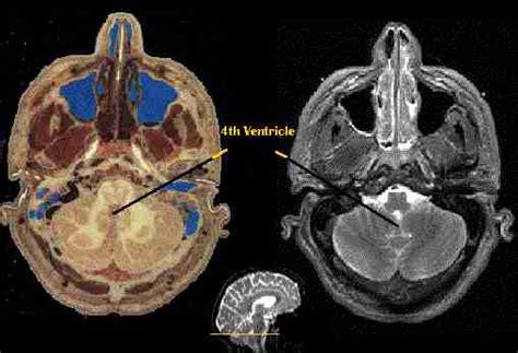 Brain Ventricular System