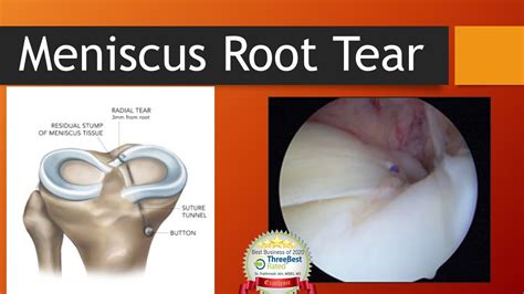 Meniscal Root Tear Important Cause Of Osteoarthritis At Young Age And