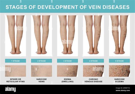 Stages Of Development Of Vein Diseases Photos Of Woman And Zoomed Skin