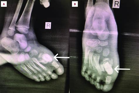 Right Foot X Ray First Metatarsal Bone Fracture And Callous Formation