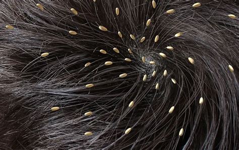 Lice Or Dandruff How To Spot The Difference