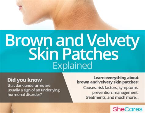 It most commonly affects the elbows and knees. Brown and Velvety Skin Patches | SheCares