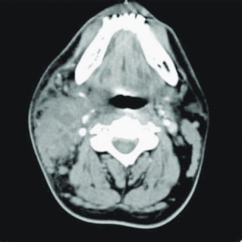 Cervical Lymph Node That Measured 35 X 2 Cm And Showing Central