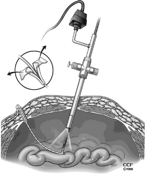 Figure 2 From Laparoscopic Ventriculoperitoneal Shunt Placement A