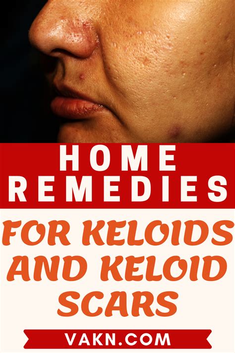 How Do You Get Rid Of A Keloid Fast Mastery Wiki
